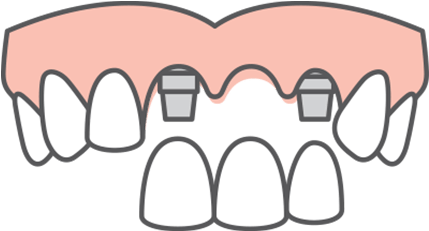Multiple Tooth Replacement If You're Missing Several - Dental Implant Icons Png (520x261)