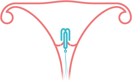A Clinician Will Insert The Small, T-shaped Plastic - A Clinician Will Insert The Small, T-shaped Plastic (619x413)