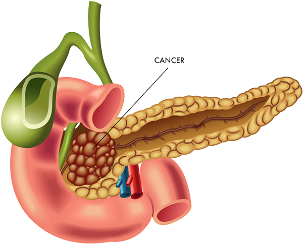 Tumors We Treat - Tumors We Treat (640x508)