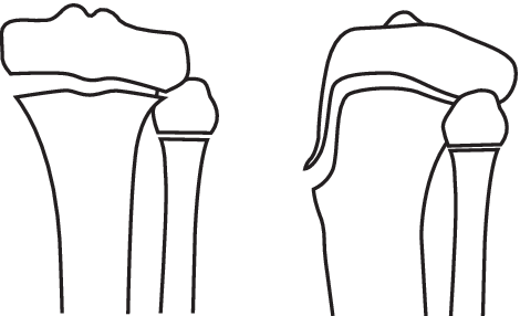 Schematic Diagram Demonstrating Our Type B Physeal - Schematic Diagram Demonstrating Our Type B Physeal (470x286)
