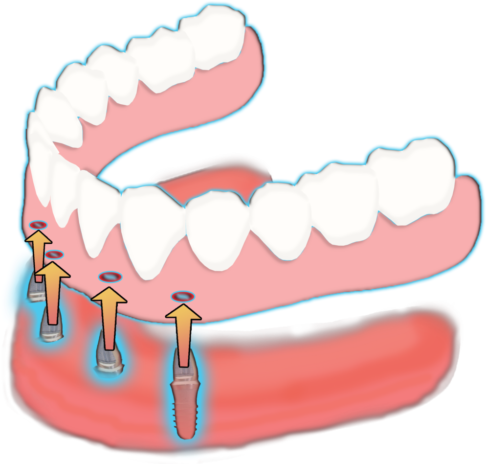 Dental Clipart Dentures - Dental Clipart Dentures (1000x1000)