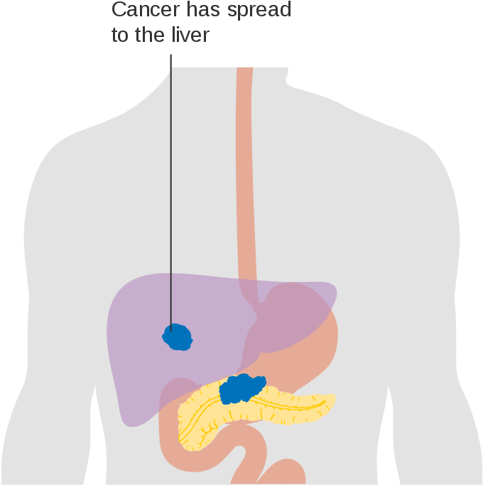Liver-cancer - Liver-cancer (787x768)