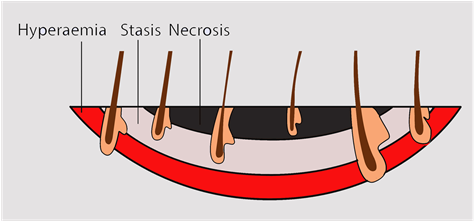 The Zones Of An Acute Burn Wound - The Zones Of An Acute Burn Wound (902x220)