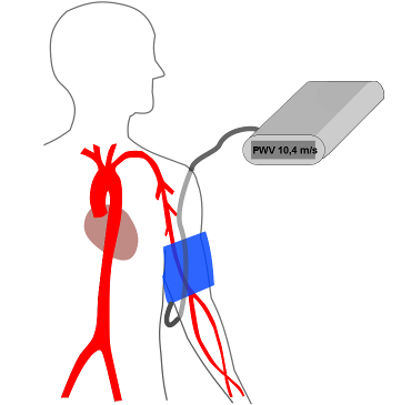 Determination Of Arterial Stiffness - Determination Of Arterial Stiffness (372x400)