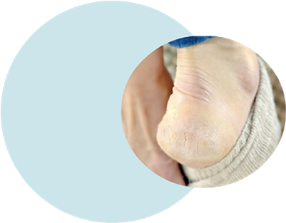 Blog The Causes Of Cracked Heels And Prevention Tips - Blog The Causes Of Cracked Heels And Prevention Tips (400x400)
