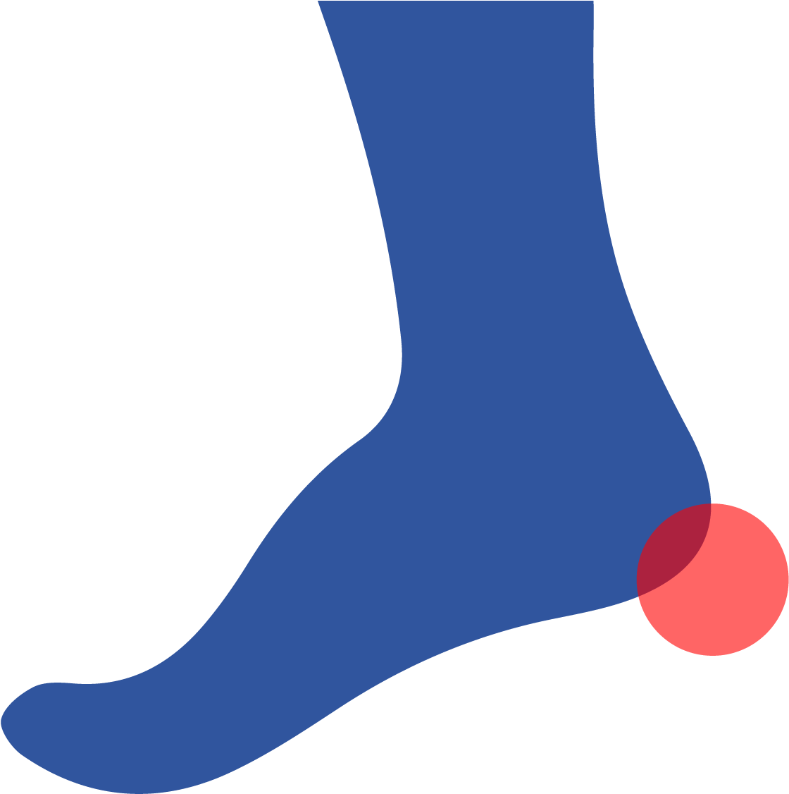 A Heel Spur Is A Calcium Deposit That Forms A Small - A Heel Spur Is A Calcium Deposit That Forms A Small (1667x1667)