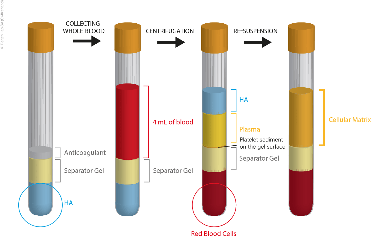 Platelet Rich Plasma Treatment - Platelet Rich Plasma Treatment (1313x858)