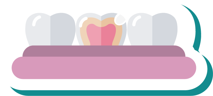 Fillings - Fillings (801x361)