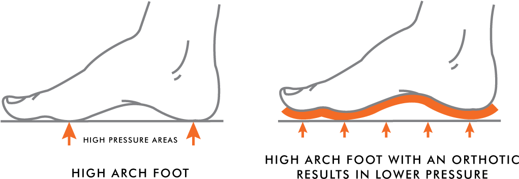High Arches Vs Low Arches - High Arches Vs Low Arches (1155x512)