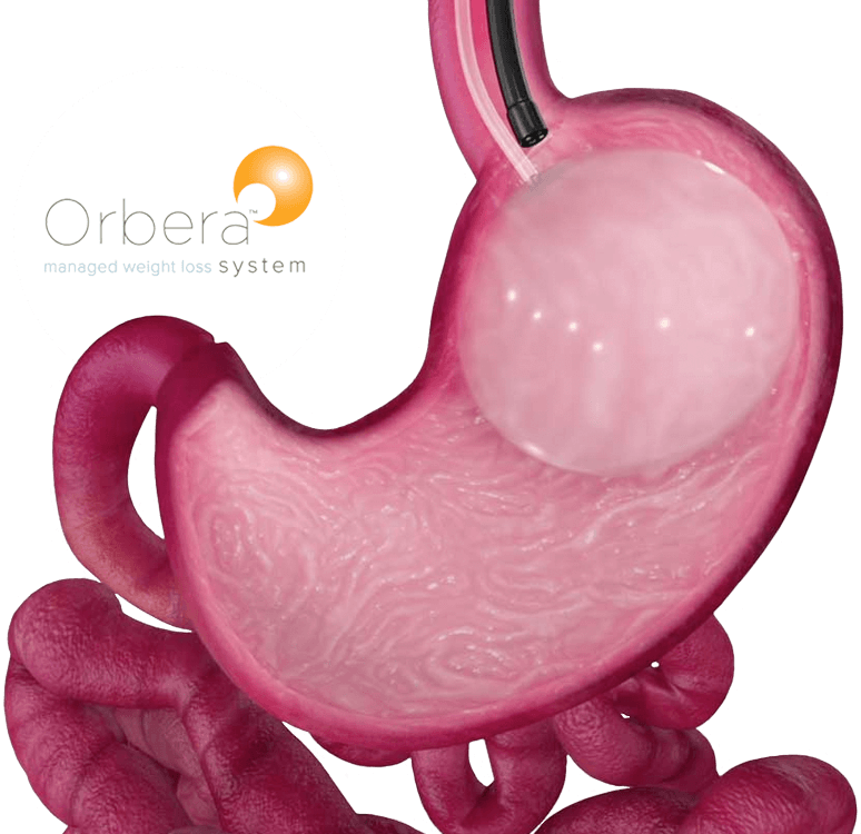 Now Offering Orbera - Gastric Balloon (774x750)