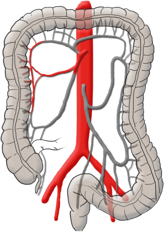 Mysurgery Carcinoma Right Colic - Operation Darmkrebs (668x800)