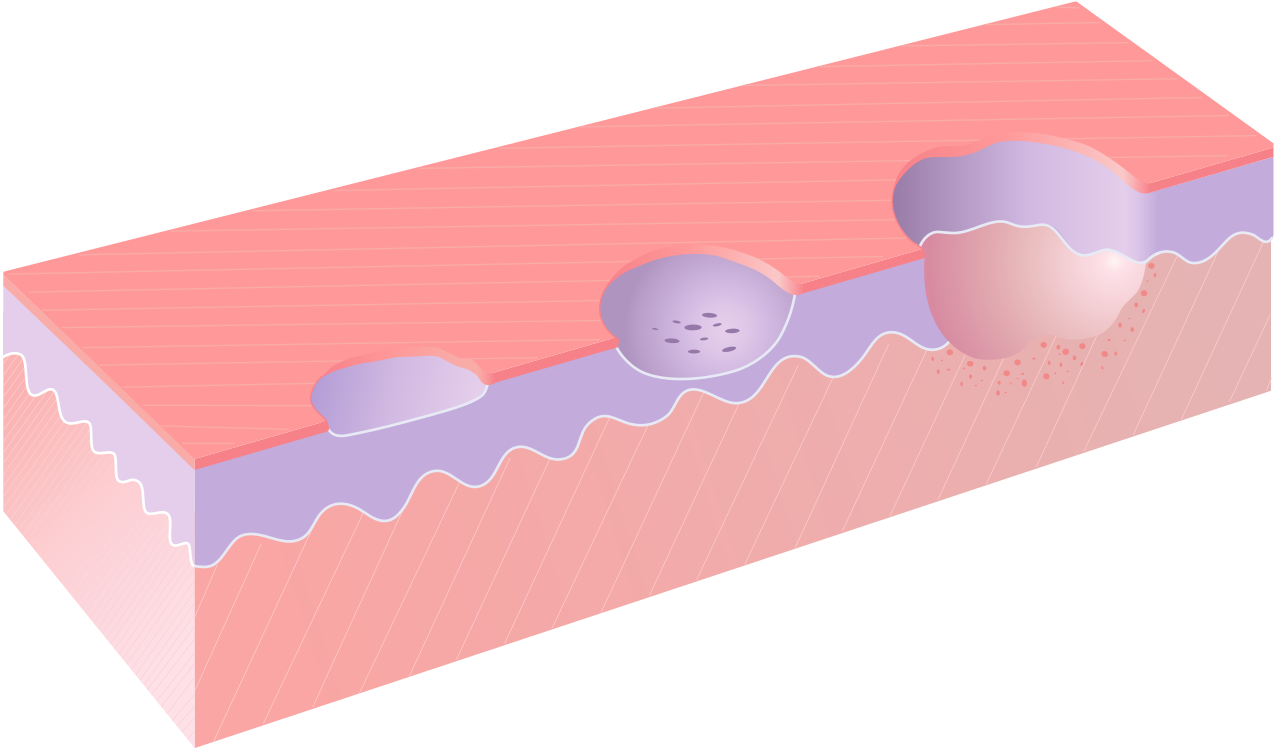 Erosion Excoriation Ulcer - Excoriation Vs Ulcer (1280x855)