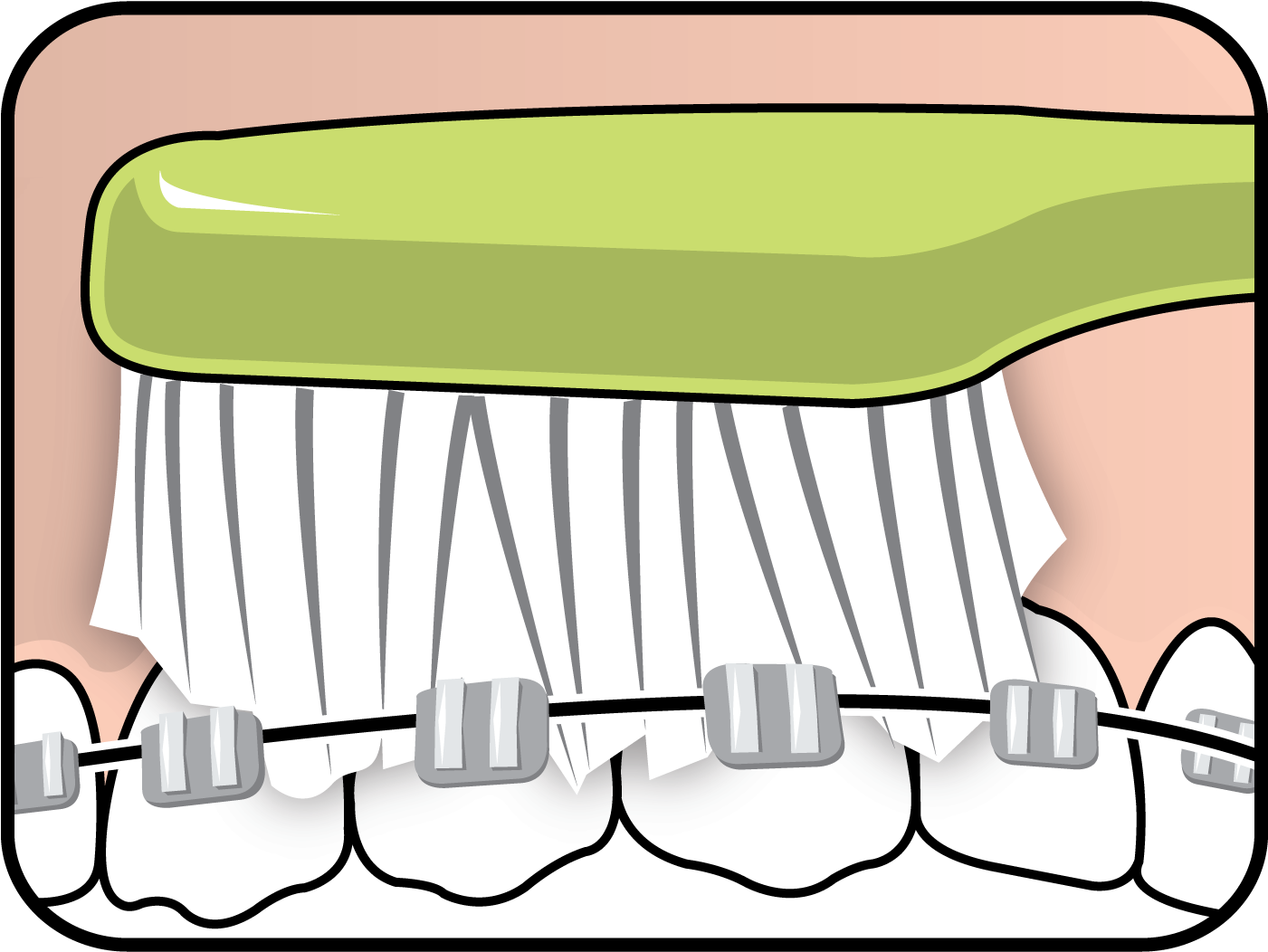 Tepe Supreme On Braces - Tepe Supreme On Braces (1500x1500)
