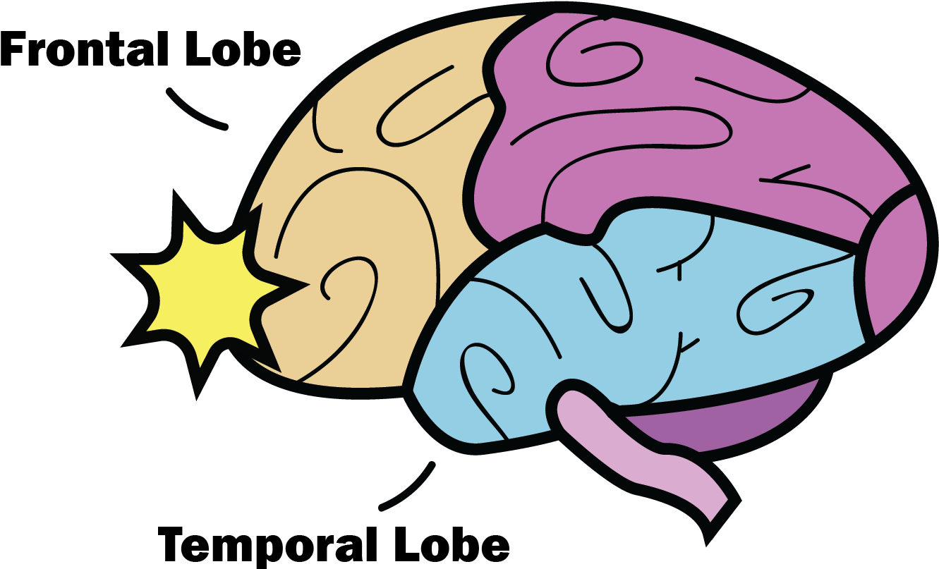 The Anatomy Of A Concussion - Concussion Frontal And Temporal Lobe (1334x818)