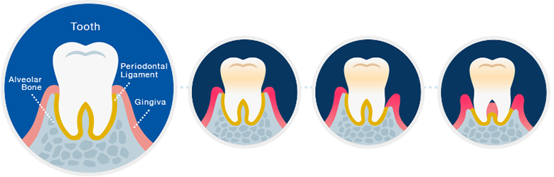 Healthy Tooth Gingivitis Moderate Periodontitis Severe - Gingivitis And Periodontitis Png (779x250)