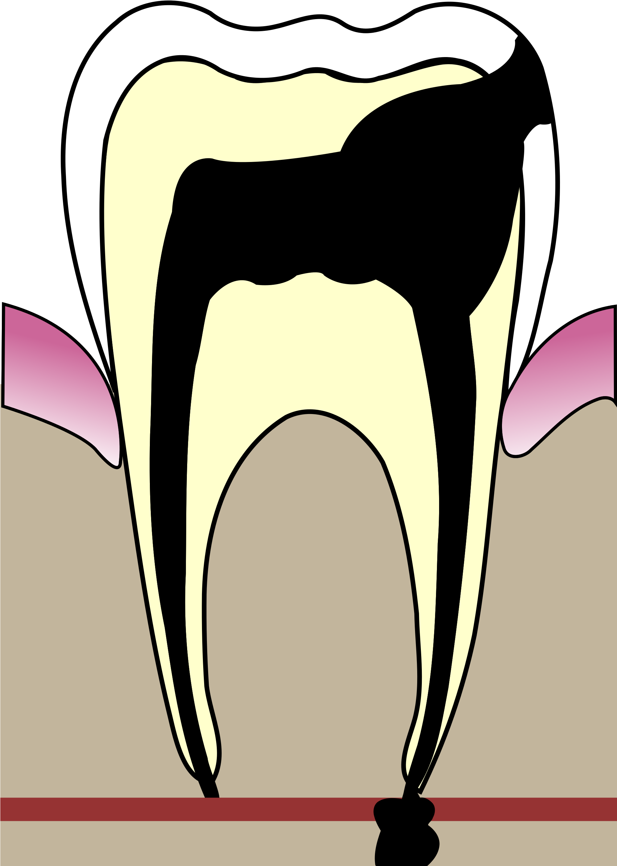 Ear Clipart Hygiene - Cavities In Teeth (2000x3018)