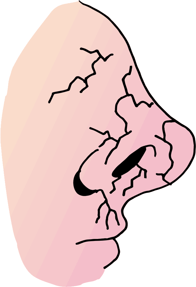 This Infections Can Be Associated With Dry Nasal Lining - Nariz Seca (1000x1000)