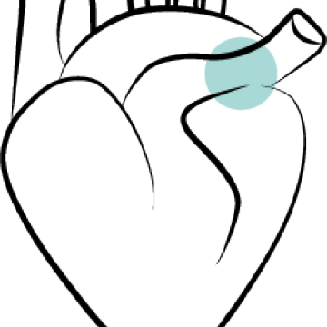 Pulmonary Arterial Hypertension When The Pressure In - Line Art (360x360)
