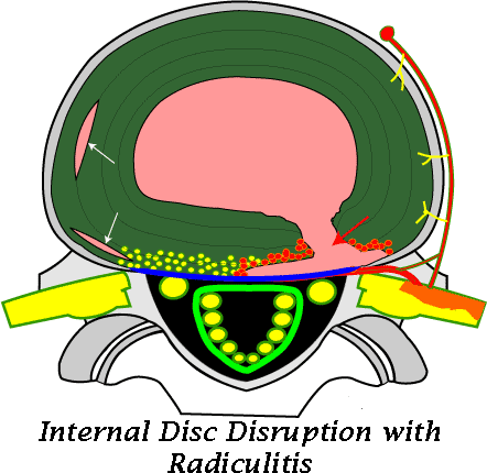 So It Is Absolutely Possible To Have An Mri Scan Reported - Annular Tear Disc (442x430)