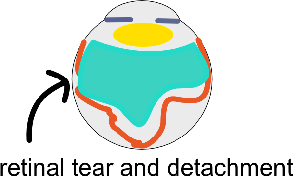 In Some Patients, The Vitreous Tug Can Cause The Retina - In Some Patients, The Vitreous Tug Can Cause The Retina (718x450)