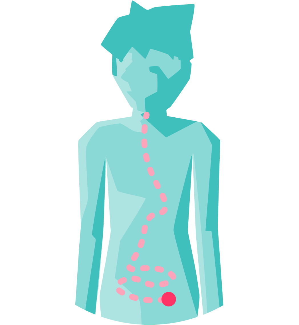 Inflammatory Bowel Disease - Illustration (1250x1160)