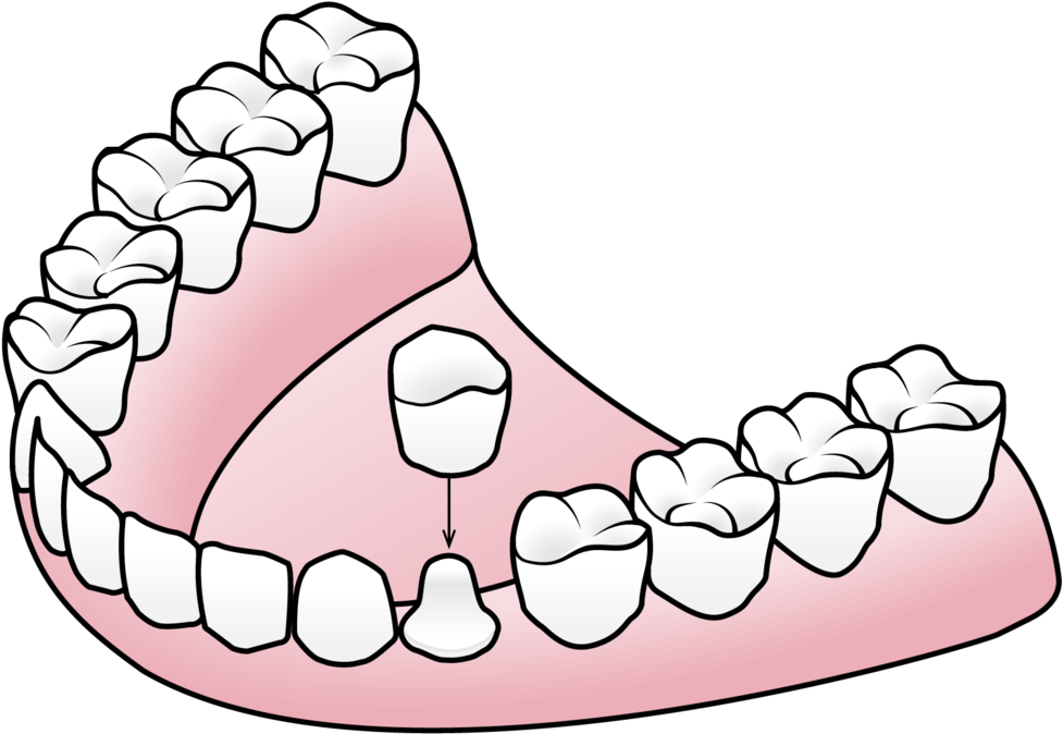 Porcelain Crowns Valley Dental And Orthodontics Clipart - Component Of Partial Denture (1000x762)