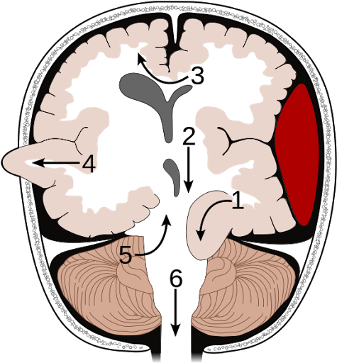 Alzheimer Disease Symptoms Screenshot 1 Alzheimer Disease - Types Of Brain Herniation (480x521)