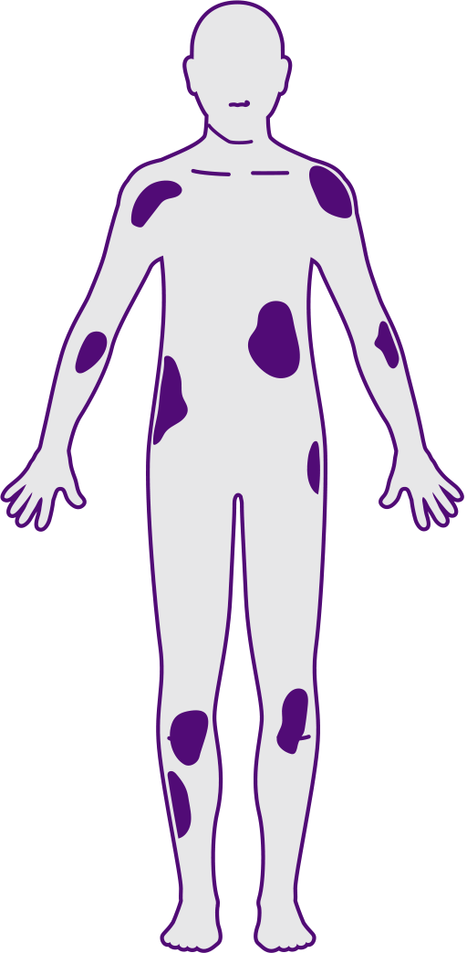 Plaque Psoriasis Severity - Plaque Psoriasis Severity (512x1043)