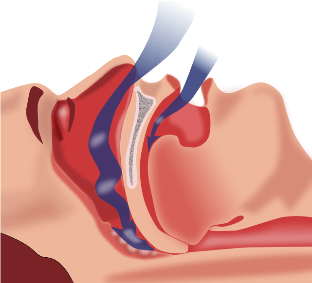 The Anesthesia Consultant - Cpap Treatment For Obstructive Sleep Apnea (640x613)