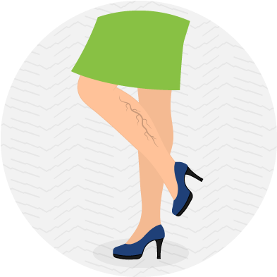 Varicose Veins Are Only A Cosmetic Issue - Illustration (400x400)