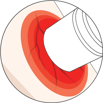 Step 3 On How To Use The Illumivein Vein Finder - Circle (424x424)