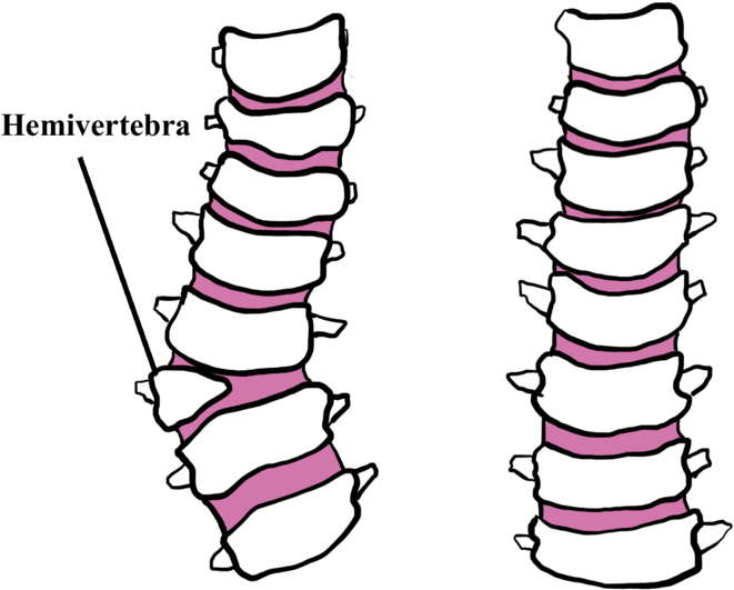 Hemivertebrae Dogs - Hemivertebra Bulldog (800x556)