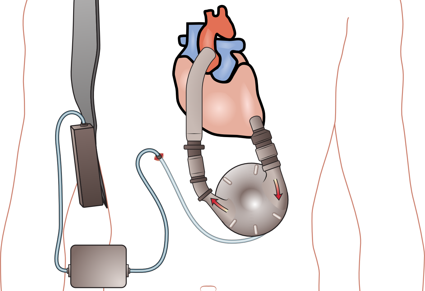 Ventricular Assist Device (1366x934)