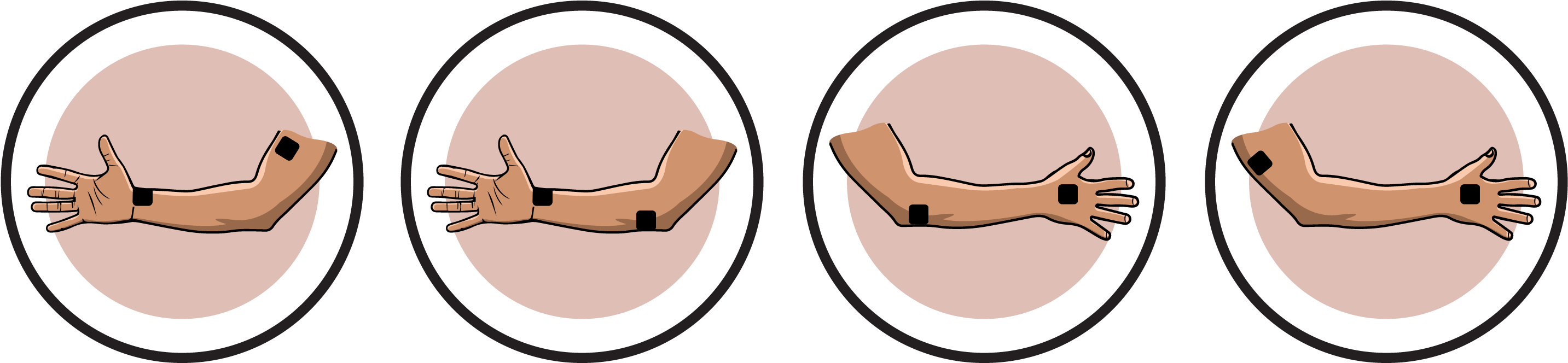 Ulnar Nerve Lesion - Kappa (2916x700)