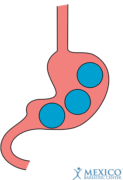Obalon Gastric Balloon - Gastric Balloon (450x640)