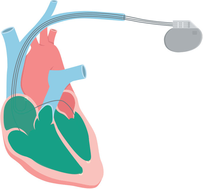 Systolic Heart Failure Also Called Systolic Left Ventricular - Systolic Heart Failure Also Called Systolic Left Ventricular (689x642)