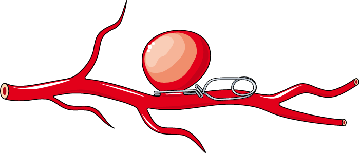 Servier Medical Art - Aneurysm Clip Art (699x298)