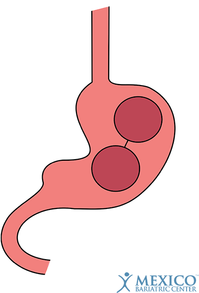Reshape Duo - Gastric Balloon (450x640)