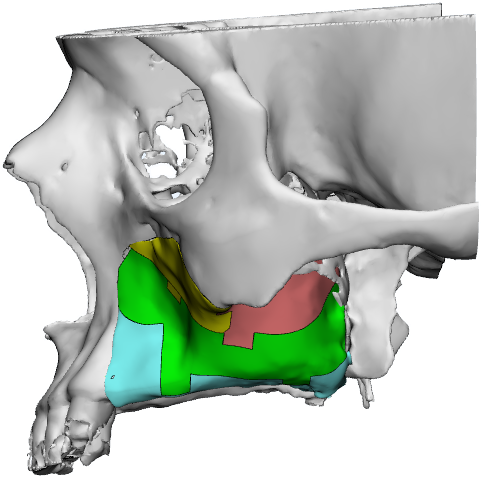 Large Maxillofacial Reconstruction Case With Smartbone® - Skull (561x556)