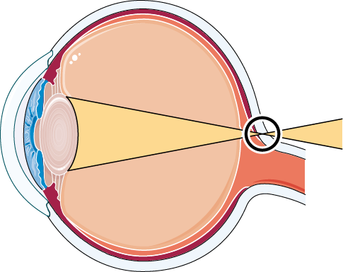 Long-sighted Eye - Astigmatism (485x385)