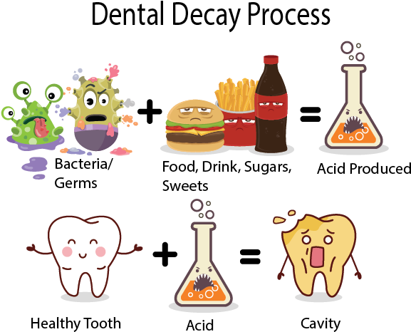 Dental Decay, Also Known As A Cavity, Is The Breakdown - Process Of Tooth Decay (578x476)