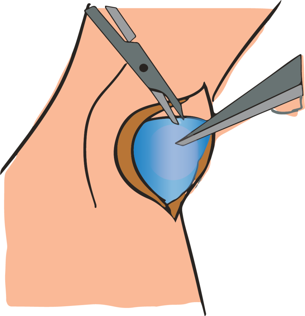 Removing Ganglion Cyst Through Surgery - Removing Ganglion Cyst Through Surgery (996x1030)