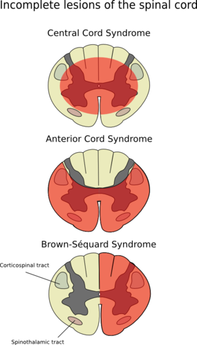 Anasarca Anterior Spinal Artery Syndrome - Spinal Cord Injury Brown Sequard Syndrome (285x499)
