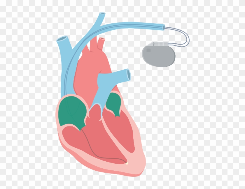 The Ventricles Beat Very Quickly And Can Lead To Ventricular - Illustration #470091