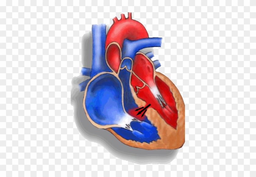 Click Link To Watch Animation Interventional Cardiology - Vsd #492167