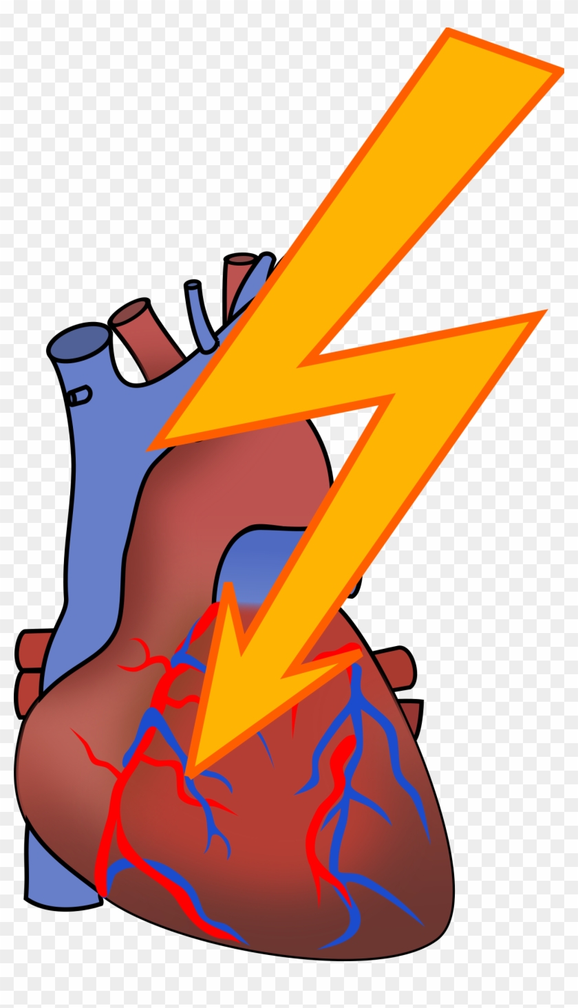 Big Image - Clip Art Heart Attack #100003