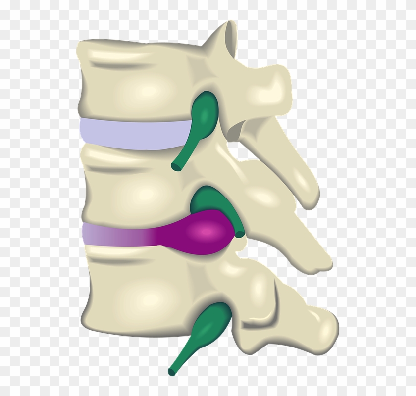 Disc Injury Herniation, Bulge, Protrusion Understanding - Spinal Disc Herniation #544822