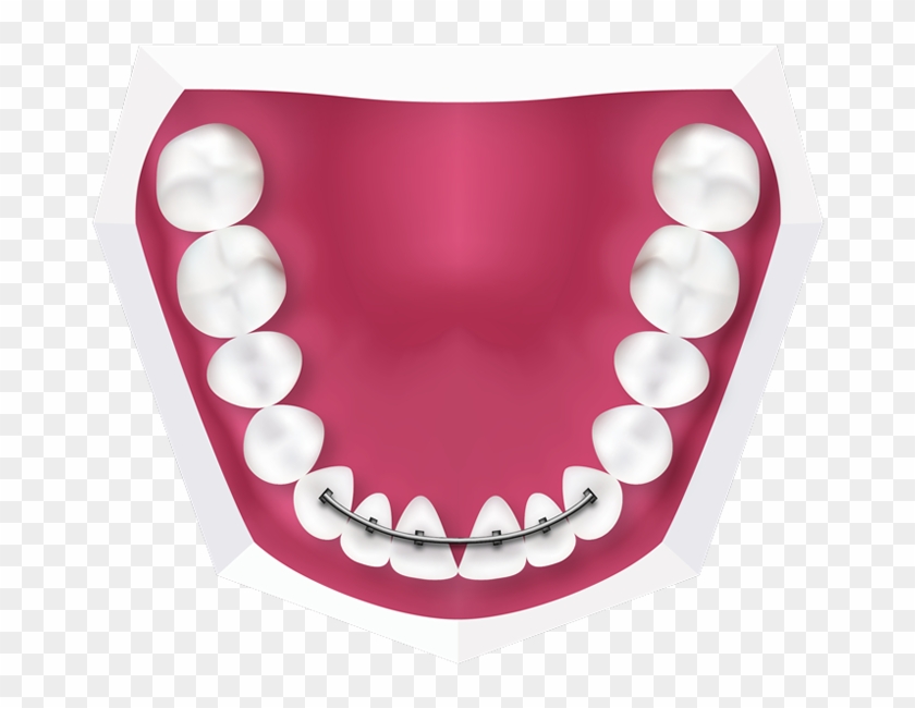 Download and share clipart about Fixed Braces At Toothbeary Fixed Retainers...