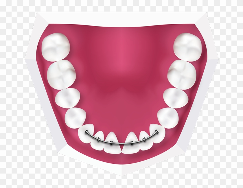 Fixed Braces At Toothbeary Fixed Retainers At Toothbeary - Human Teeth Model #554082