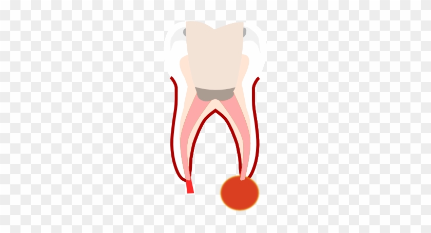Preparation Of The Root Canals - Preparation Of The Root Canals #563334